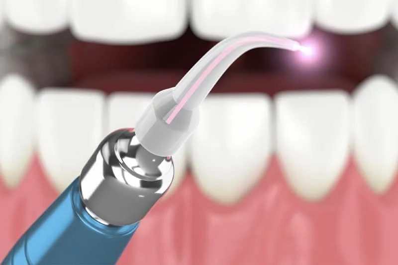 Laser dentistry at Little Teeth